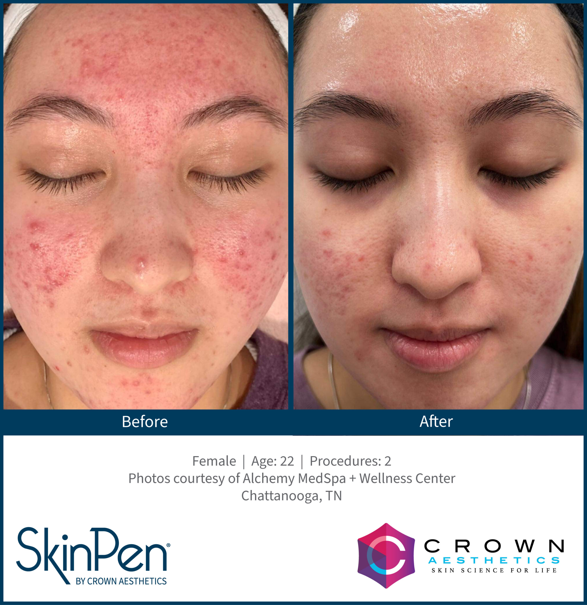 Acne_Female_22_2Treatments_AlchemyMedSpa_Chattanooga_v1