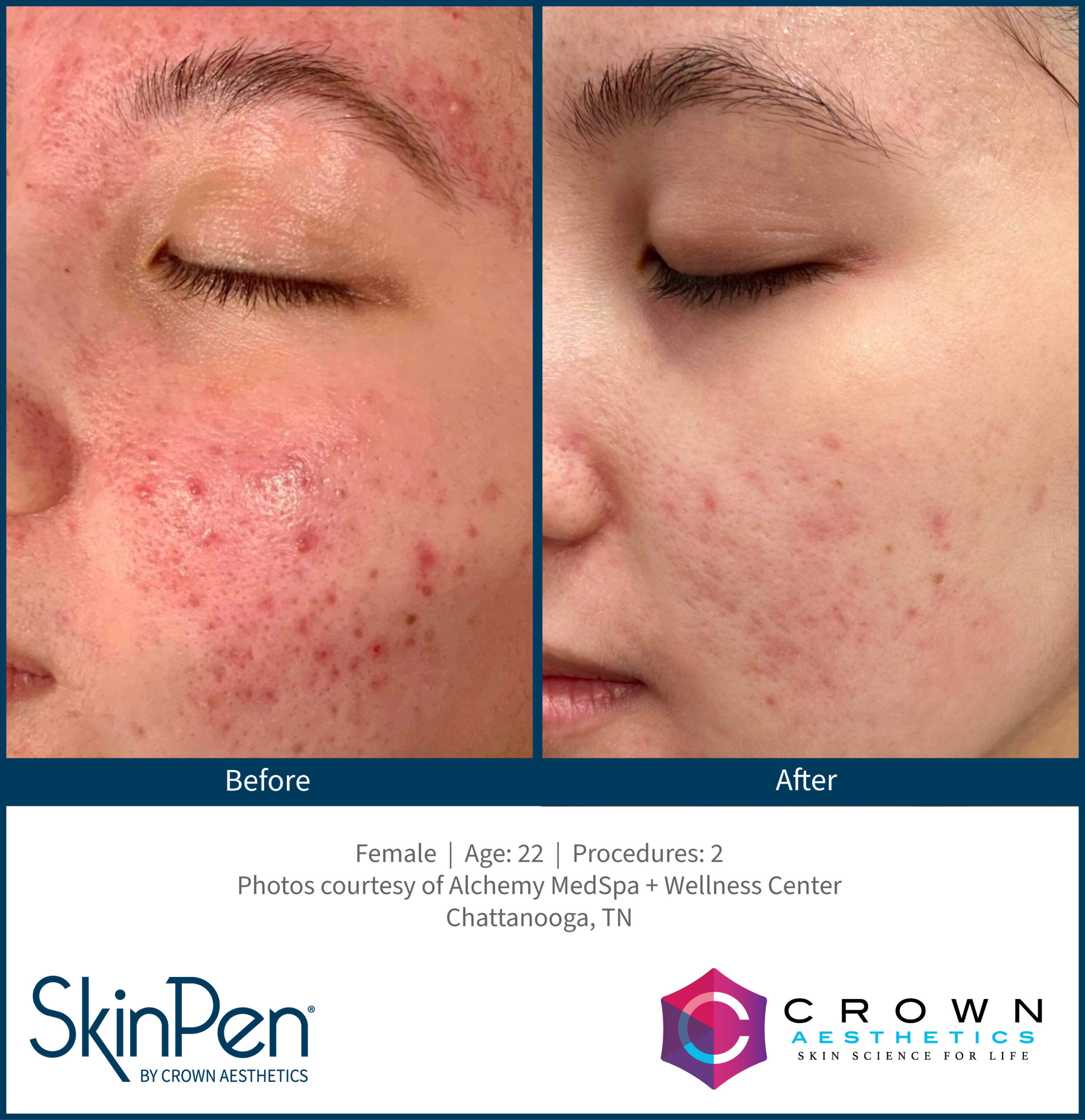 Acne_Female_22_2Treatments_AlchemyMedSpa_Chattanooga_v2