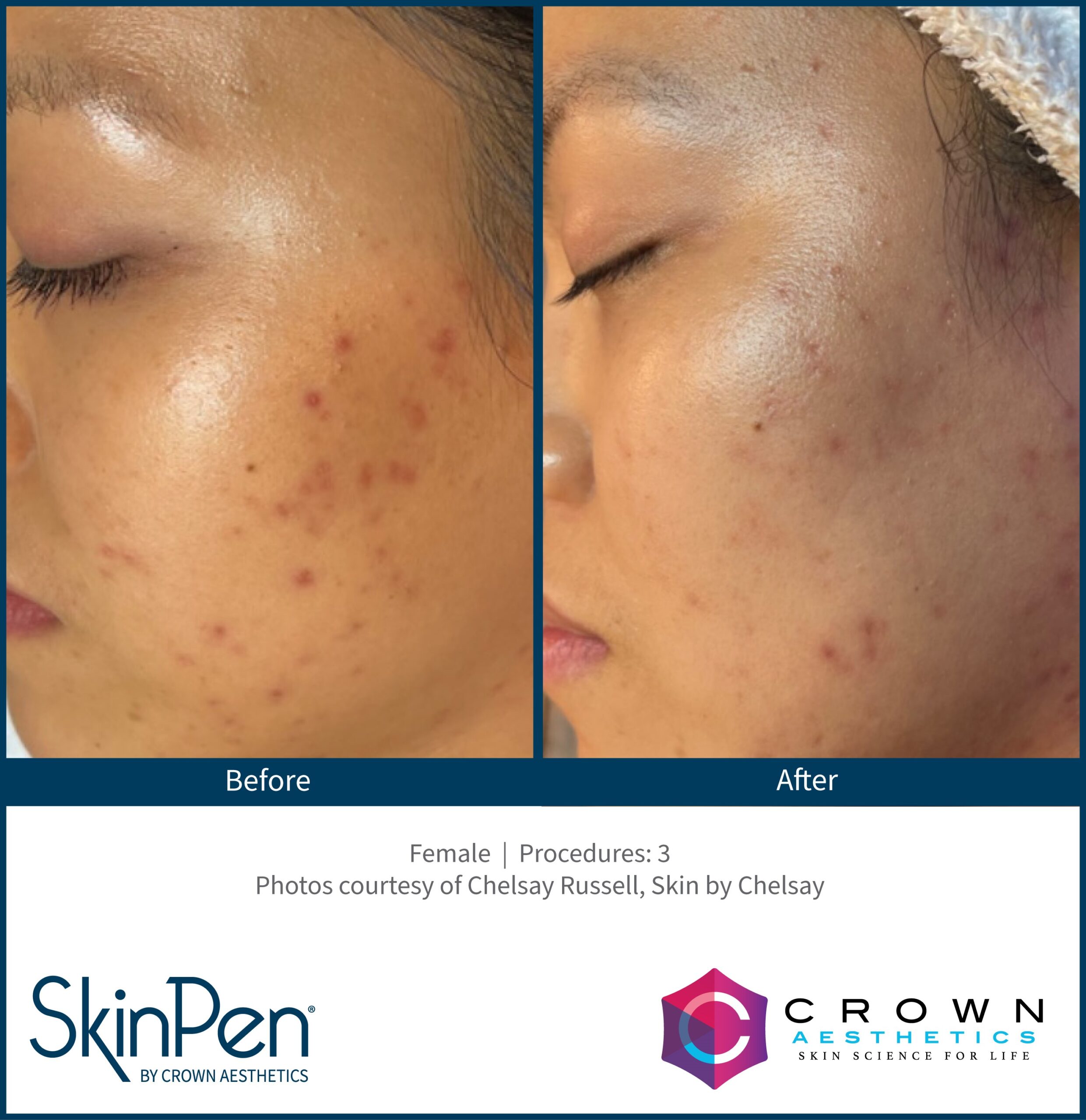 Acne_Female_3 sessions