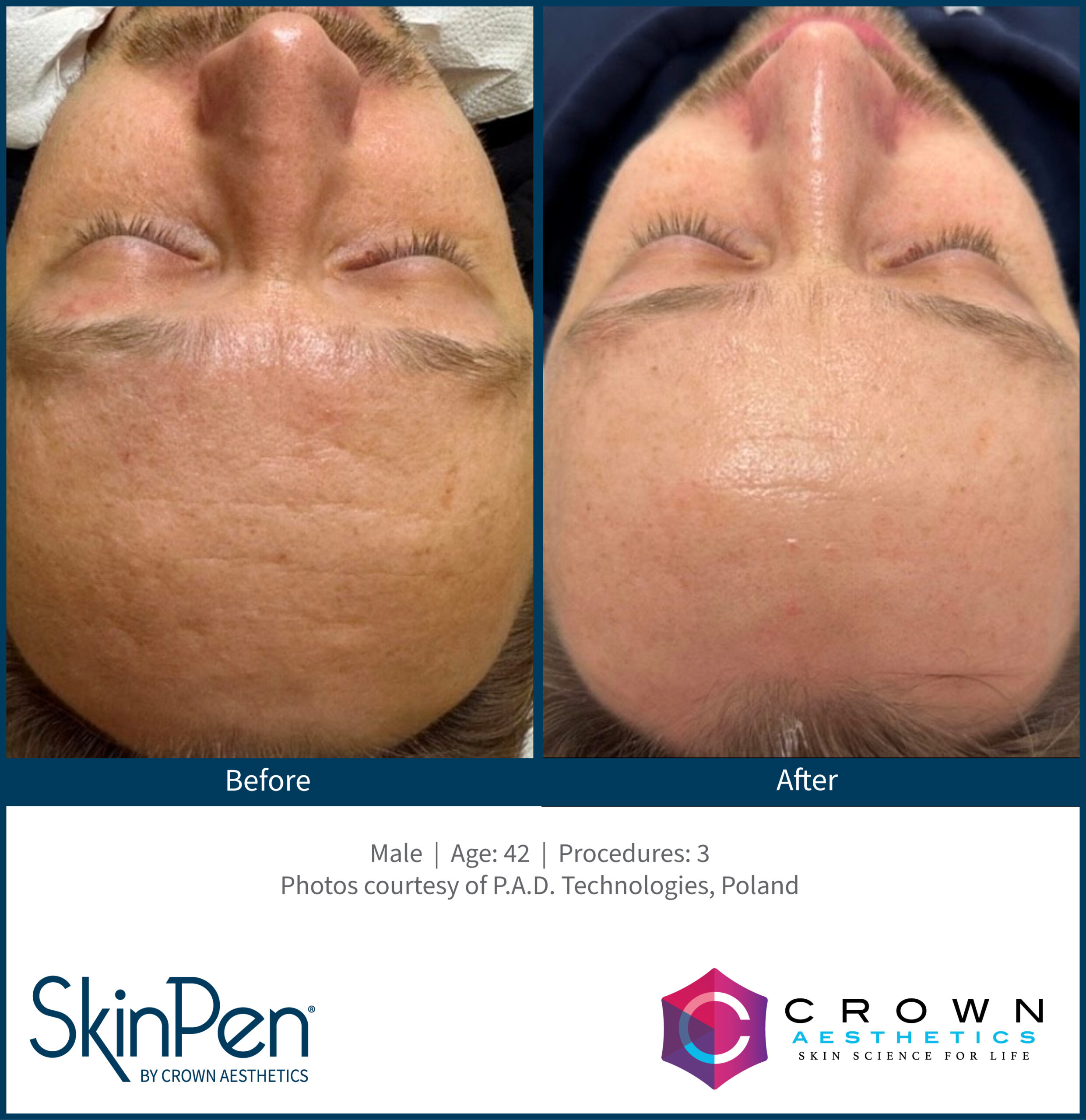 Acne_Female_22_2Treatments_AlchemyMedSpa_Chattanooga_v1