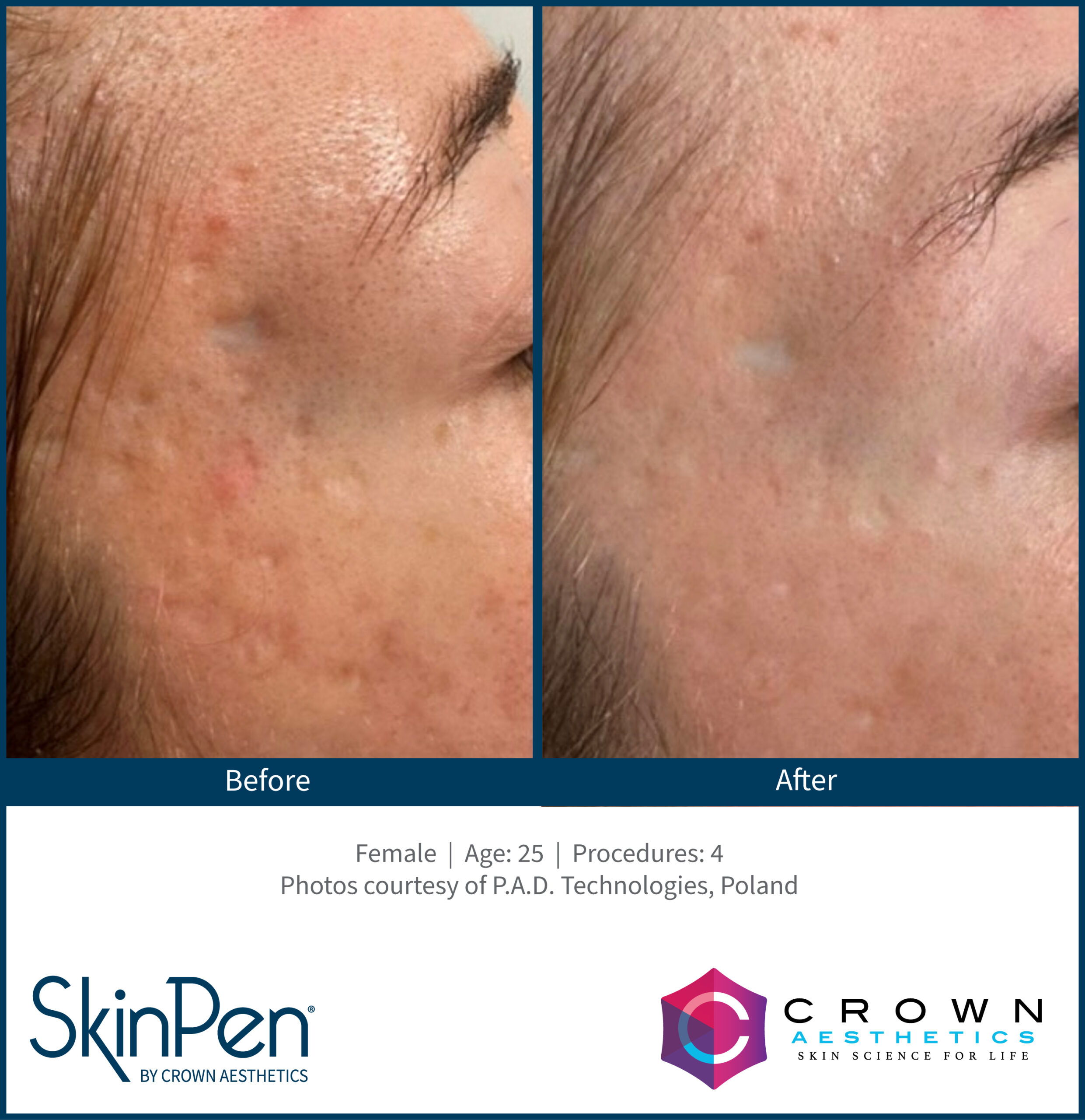 Acne_Female_22_2Treatments_AlchemyMedSpa_Chattanooga_v1