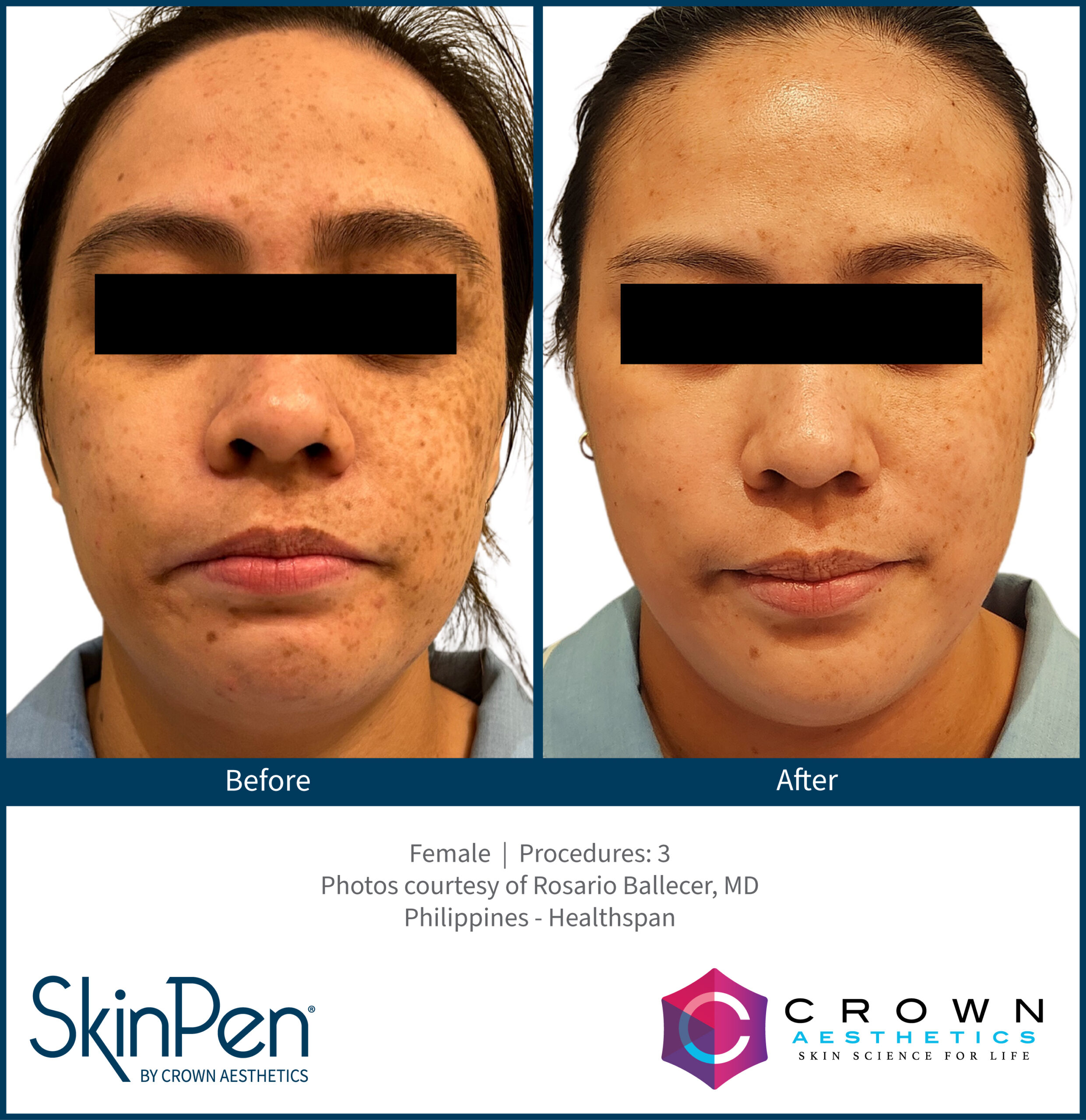 Acne_Female_22_2Treatments_AlchemyMedSpa_Chattanooga_v1