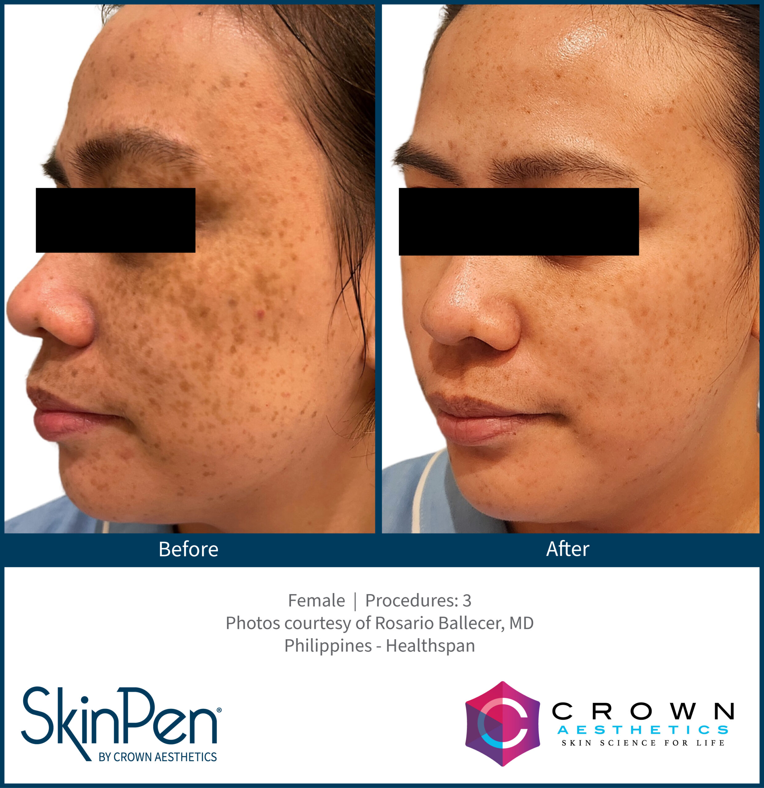 Acne_Female_22_2Treatments_AlchemyMedSpa_Chattanooga_v1